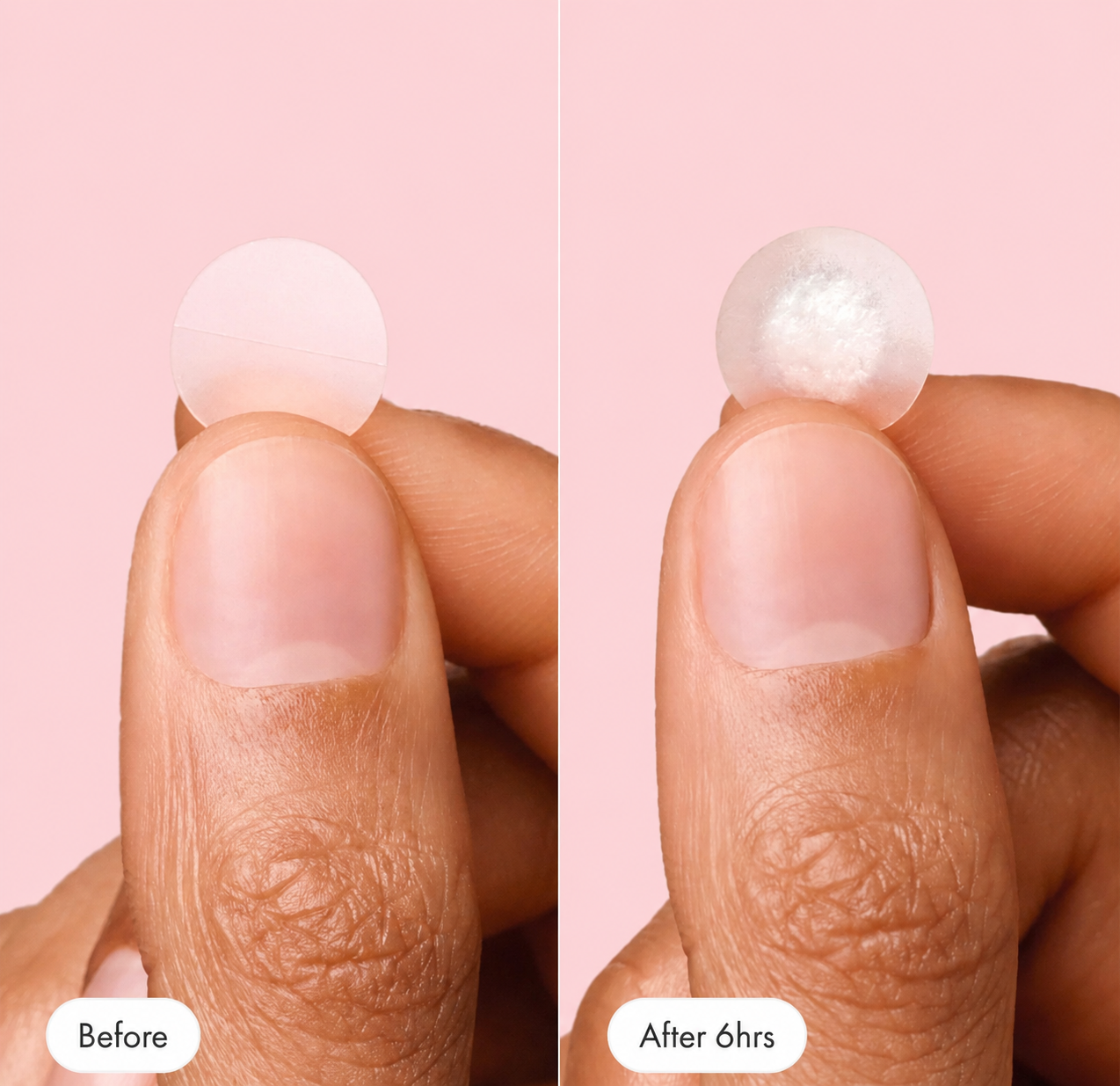 Pimple Patch™
