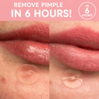 Pimple Patch™